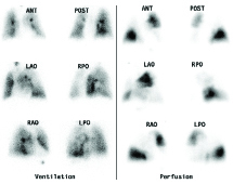 Lung Scan